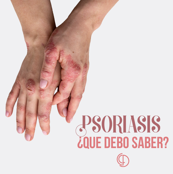 ¿Qué debes saber sobre la Psoriasis?