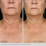 ELASTIderm® Neck and Décolleté Concentrate