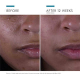 Silymarin CF Salicylic Acid Acne Treatment